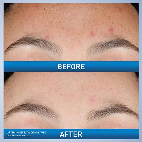 CeraVe - Sérum de retinol para marcas posteriores al acné y textura de la piel | Sérum facial refinador, rejuvenecedor e iluminador de poros con retinol | 1 onza