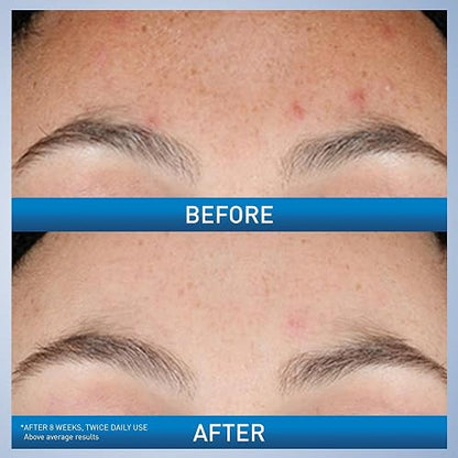 CeraVe - Sérum de retinol para marcas posteriores al acné y textura de la piel | Sérum facial refinador, rejuvenecedor e iluminador de poros con retinol | 1 onza
