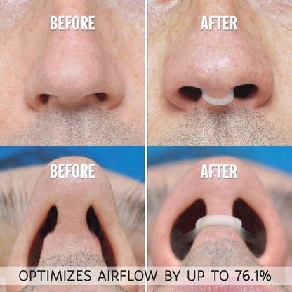 AIRMAX Nasal Dilator for Better Sleep - Natural, Comfortable, Anti Snoring Device, Snoring Solution for Maximum Airflow and Easier Breathing (Small – Clear)